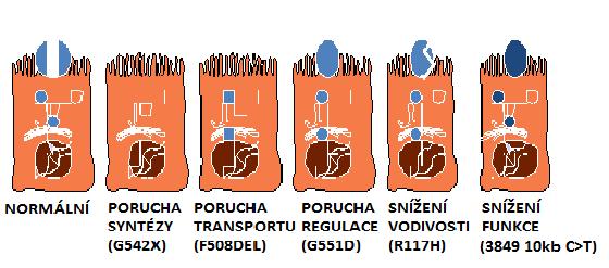Obr. 2: Základní třídy mutací v CFTR genu se zástupci nejčastějších mutací těchto tříd. Upraveno podle Boyle (2013). Dostupné z http://www.medscape.org. 2. 4 Diagnostika cystické fibrózy Diagnostika cystické fibrózy by měla být provedena co nejdříve a co nejspolehlivěji, aby mohla být indikována léčba klinických příznaků tohoto onemocnění.