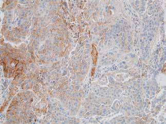 43 Imunohistochemická pozitivita nádorových buněk PD-L1 pozitivity nádorových elementů kolísavé intenzity v cca 40% ho množství tukových buněk významně snižuje množství a kvalitu izolované DNA; (iii)