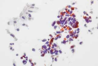Buňky mají středně anizomorfní jádra s typickou chromatinovou strukturou, cytoplazma je poměrně bohatá, často excentricky uložená. Obr. 8 High-grade neuroendokrinní tumor malobuněčný karcinom.
