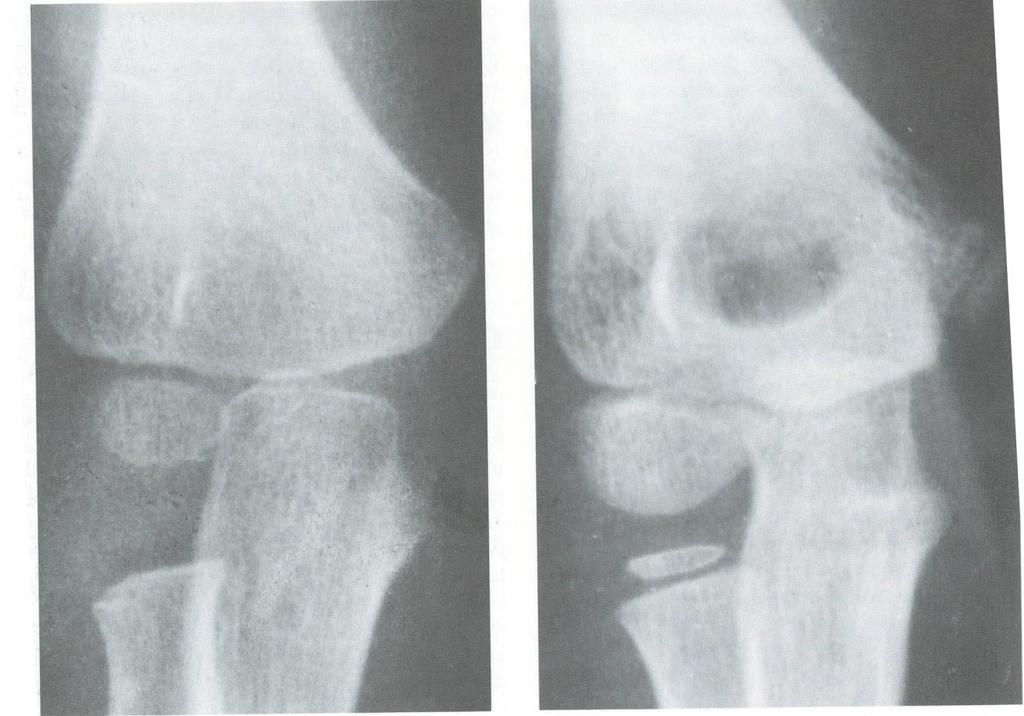 Articulatio cubiti
