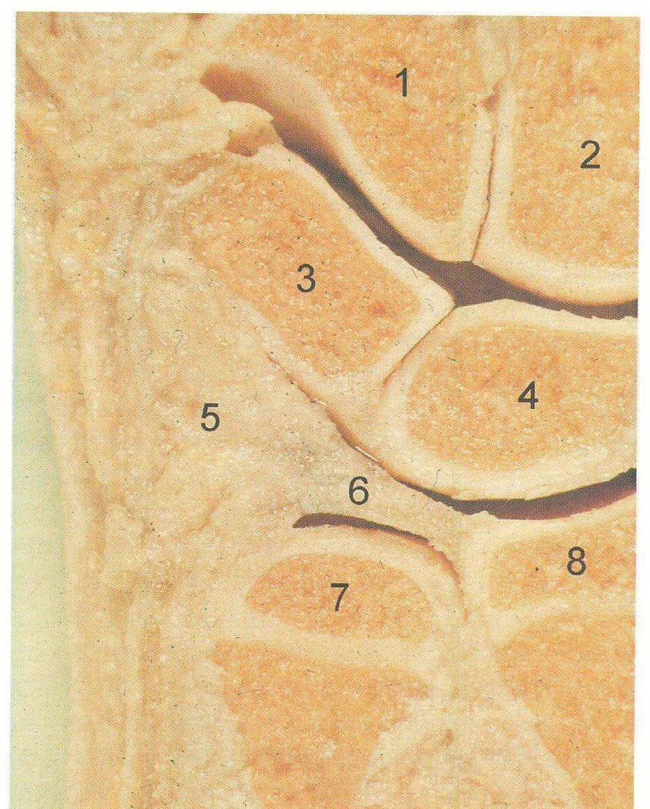 Articulatio radiocarpalis 3 Triangulární fibrocartilaginózní komplex (TFCC) 1 Discus articularis 2 Ligamentum