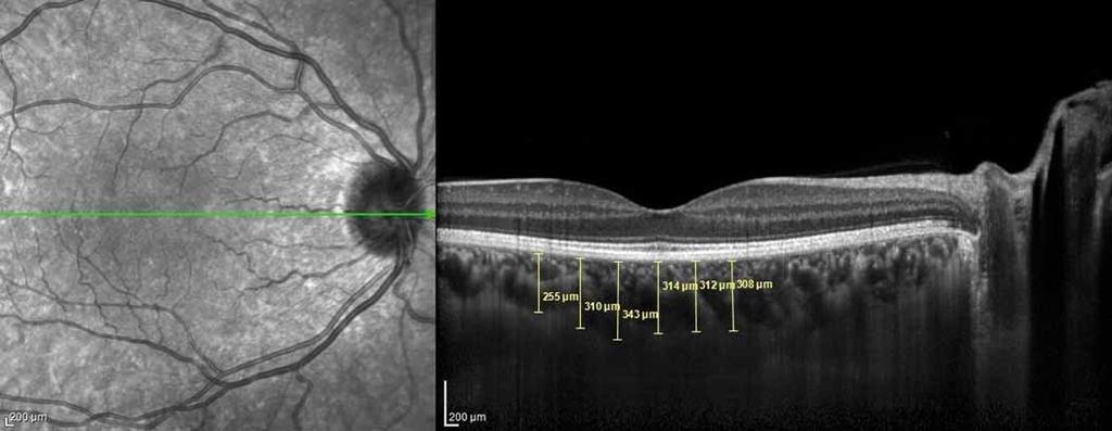 DOES CHOROIDAL THICKNESS CHANGE IN PARKINSON S DISEASE? Fig.. Choroidal thickness measurements performed at 6 points at 5-μm intervals in the optic coherence tomography cross-section. Obr.