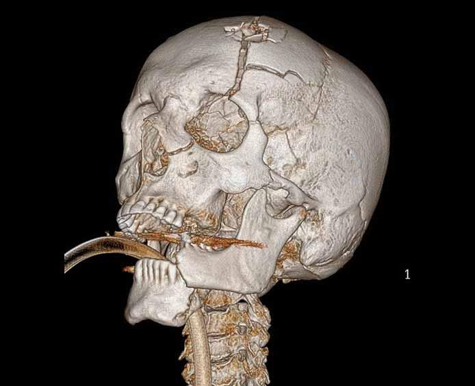 Bílá šipka ukazuje na frakturu čelní kosti v kontinuitě s výstřelem pokračující přes orbitu do horní čelisti. Fig. 3. 3D skull reconstruction of the patient after a gunshot wound.
