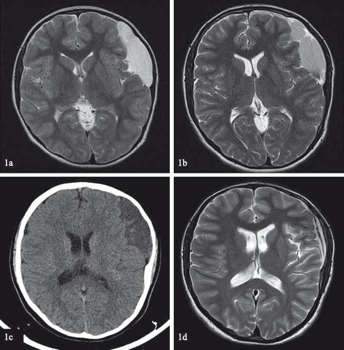 CONSERVATIVE MANAGEMENT OF A RUPTURED GALASSI III MIDDLE FOSSA ARACHNOID CYST on a follow-up MRI, with no signs of intracranial hypertension or focal neurolo gical deﬁcit.
