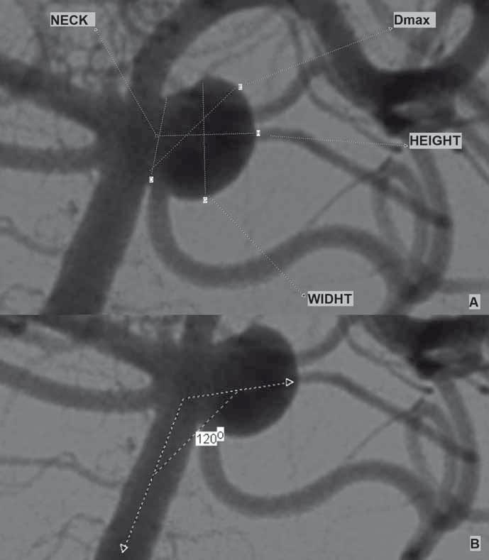 A COMPARISON OF PERIOPERATIVE PRESSURE MEASUREMENTS IN THE ANEURYSM SAC AND PARENT ARTERY However, there was no statistically signiﬁcant diﬀerence between the groups in the aneurysm morphological
