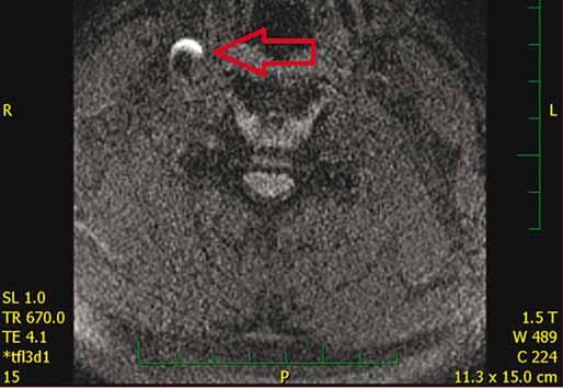 . Echolucent part of atherosclerotic plaque > 8 mm on duplex ultrasound evaluated as intraplaque hemorrhage. Obr.