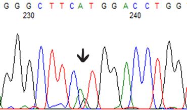 D) Obr. 18: Mutace v genu CYB5R3. A) SNP c.132g A (pacient 1) B) c.400g>a, exon 5 (pacient 1) C) c.890g>a, exon 9 (pacient 2) a D) c.316g A, exon 4 (pacient 3).