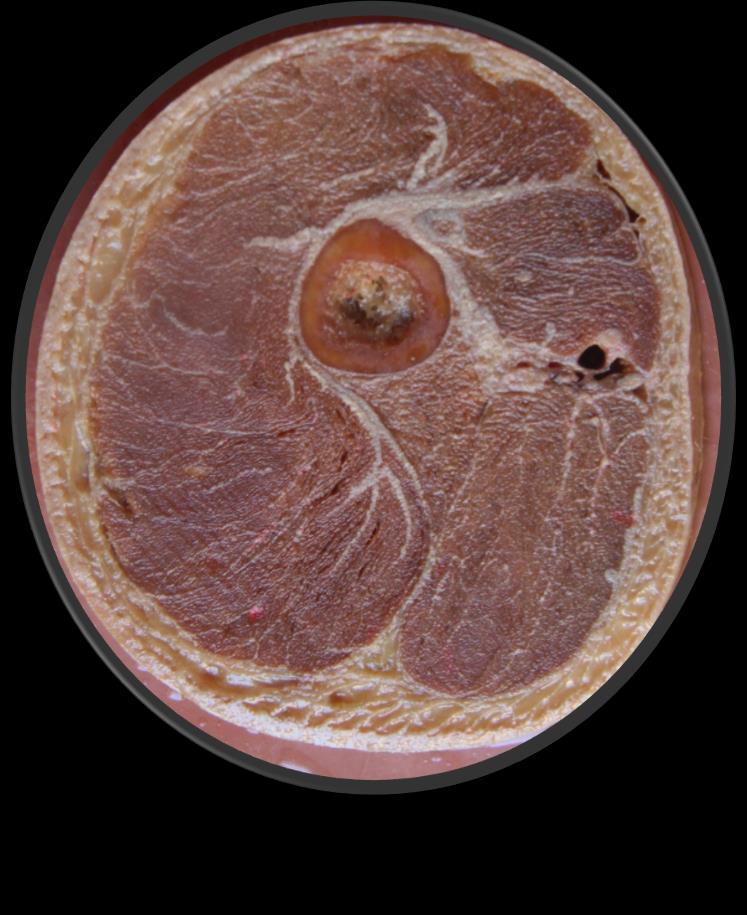 iliotibialis, septum femorale