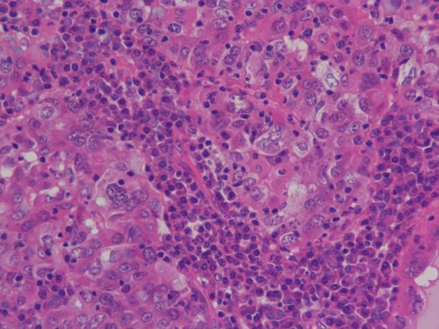 Proliferation of epithelial tumour cells surrounded by an