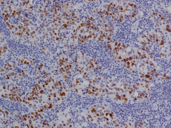 nuclei with prominent nucleoli (haematoxylin and eosin,
