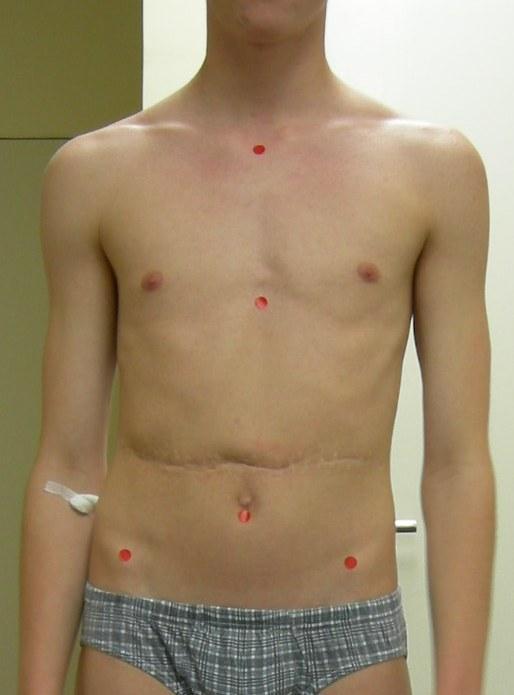 Při vyšetření jizvy (obrázek 18) jsme zkoumali její posunlivost a elasticitu, případně palpační bolestivost.
