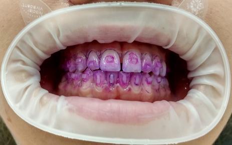 Vyšetření V rámci vyšetření proběhlo vyhodnocení hygienických indexů. CPITN: 111/111 KOD: 15 QHI: 45 Obrázek 18, Pacientka s ortodontickým aparátem po obarvení (1.