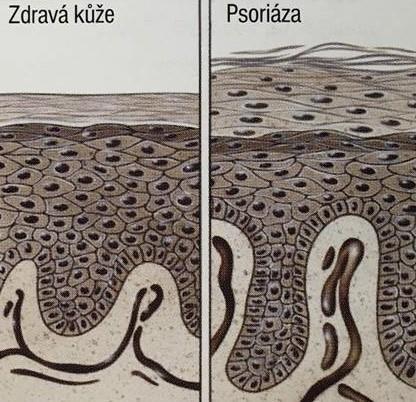 keratinocytů, ale i celé keratinové buňky, které produkují cytokiny jako např. TNF alfa (tumor nekrotizující faktor alfa) působící prozánětlivě a udržující psoriatický fenotyp.