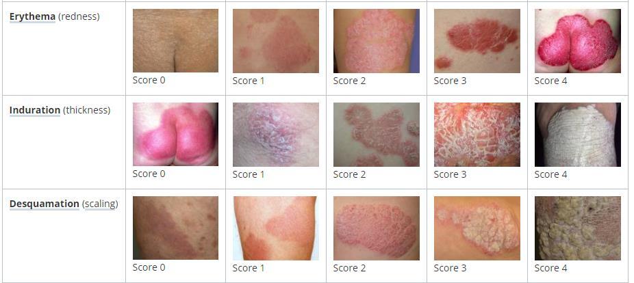 Obrázek 11 Hodnocení PASI projevy 3.2 Ostatní hodnotící testy (DLQI, CDLQI) Psoriáza je onemocnění, které vykazuje zásah do kvality života pacienta a jeho okolí.