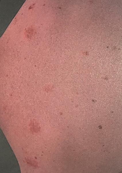 Xamiol gel 60 g, ÚL kalcipotriol + betamethason-dipropionát kombinace deltanoidu a KS.