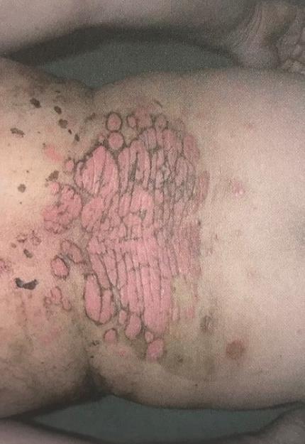 Obrázek 15 Projevy psoriázy před léčbou cignolinem Obrázek 16 Projevy psoriázy po léčbě cignolinem Lokální imunomodulátory jsou léčiva s protizánětlivými účinky srovnatelná s mírnými až středně