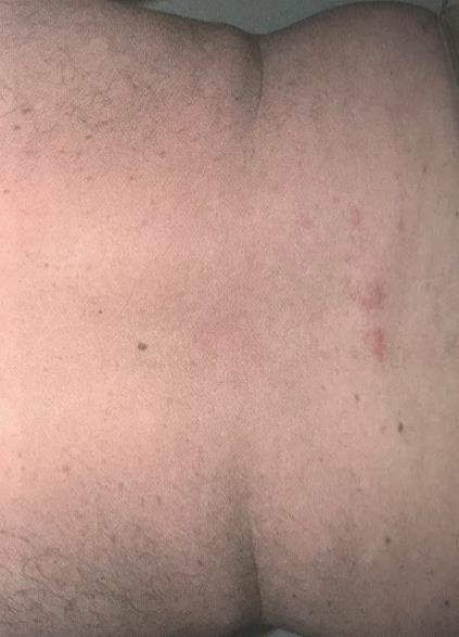 Jsou používány zejména u pacientů s atopickou dermatitidou, u psoriatiků lze zahájit léčbu u ložisek nacházejících se na obličeji, očních víčkách a genitálu nebo v případech, kde nelze dlouhodobě