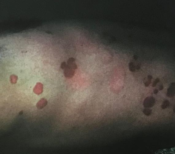 [17] UVB záření je nejúčinnější složkou UV spektra v léčbě psoriázy. Jeho síla je přirovnávána k síle slunečního záření v poledních hodinách, kdy je slunce nejintenzivnější.
