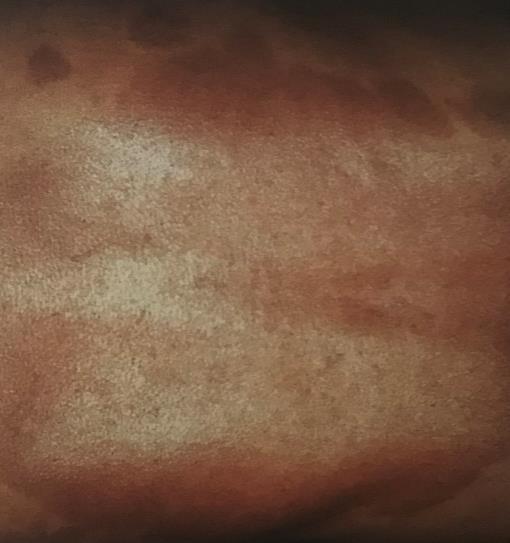 UVA záření je nejslabší složkou UV spektra, samotné nemá dostatečný léčebný efekt, proto se používá v kombinaci s psoraleny látky zvyšující senzitivitu kůže, jde o tzv. PUVA léčbu.