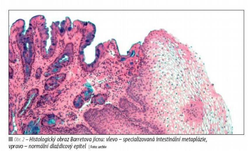 Obrázek 4 Histologický obraz Barretova jícnu (7) 1.6 Dyspepsie Dyspepsie je nejběžnější příznak vznikající poruchou činnosti trávicího ústrojí.