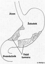 - genetické predispozice - infekce Helicobacterem pylori - polypy - Karcinom se může vyvinout také z některých polypů (výrůstky na sliznici), které nejsou nijak škodlivé.
