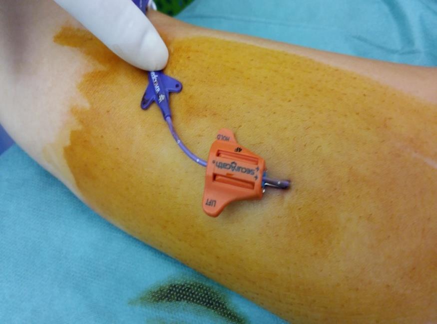 PICC - indikace Chemoterapie Domácí a dlouhodobá parenterální výživa - do 12 měsíců Dlouhodobá