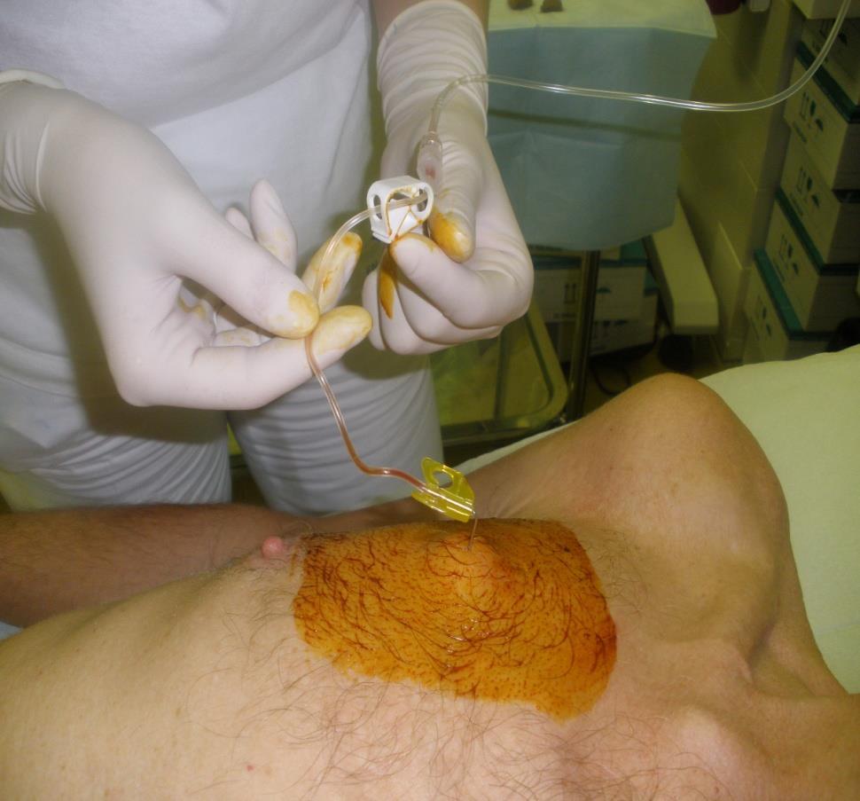 Intravenózní port Chemoterapie dlouhodobě podávaná Domácí parenterální výživa byl-li port zaveden v předcházejícím