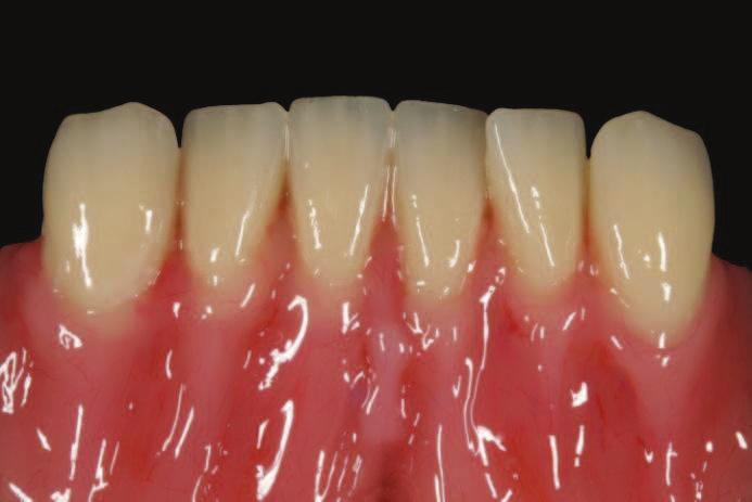 Vlevo: Pastou Gingiva-Masse shade 200 zvýrazněte kořeny zubů.