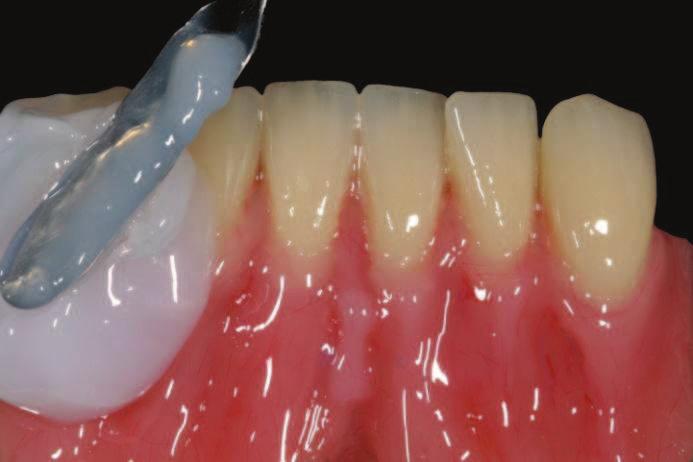 Vlevo: Jemné detaily můžete nakonec doplnit pastou Gingiva-Masse R50 a mezipolymerujte. Vpravo: Protéza připravená na závěrečnou polymeraci.