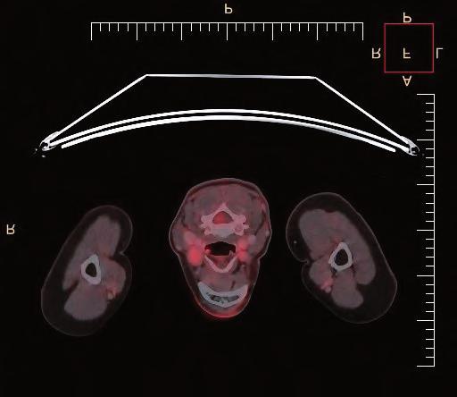 Ve výši C 5 obratle bylo sonograficky zachyceno aneuryzma vertebrální arterie maximálního diametru 9 mm, kde na zadní stěně opět zachycen izoechogenní obsah.