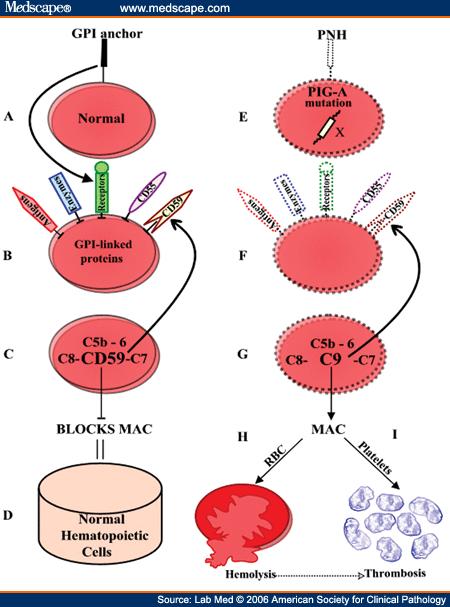 PNH - molekulární podstata choroby: 4. Mutace genu PIG-A (fosfatidylinositol glykan třídy A).
