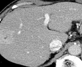 Diagnóza Transarteriální chemoembolizace hepatocelulárního karcinomu MUDr.