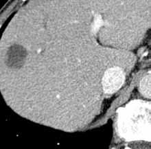 Konvenční TACE však bývá často kritizována jako nestandardizovaný výkon (různá chemoterapeutika a dávky, různý embolizační materiál).