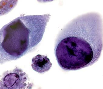 BK polyomavirová infekce asymptomatická virurie, viremie BK nefropatie (PVAN) ulcerace a stenóza ureteru