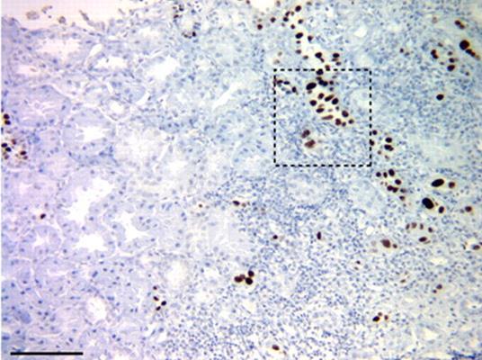 Cidofovir (CAVE nefrotoxicita)