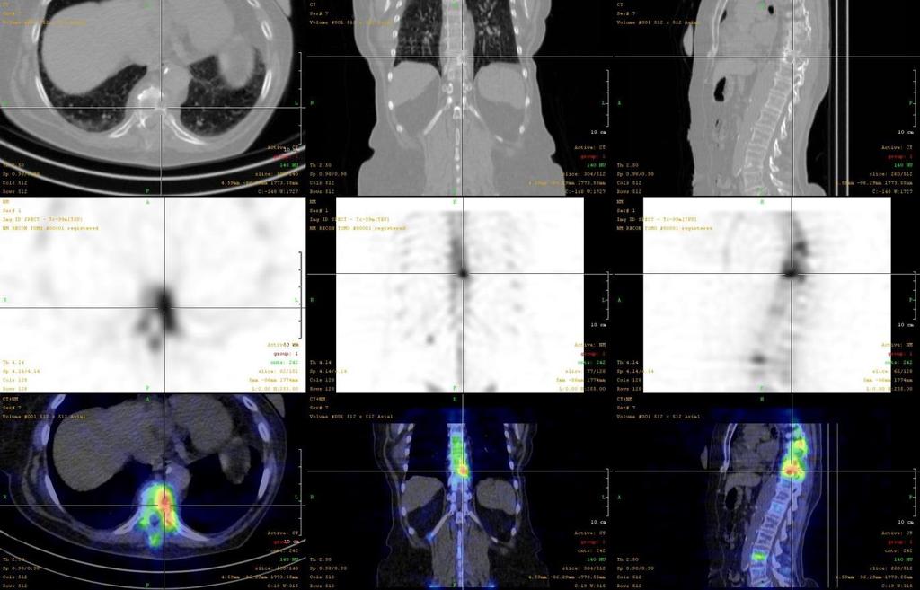 Používané CT může být velmi jednoduché a určené zejména pro hrubou morfologickou orientaci a atenuaci, nebo může být multidetektorové a jeho použití může být i pro CT diagnostiku (přehled uvádí