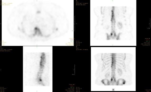 Obrázek 3.2.2-2 Tomografické SPECT vyšetření s typicky benigním nálezem na Th páteři odpovídající spondylóze 3.2.2.8.1.