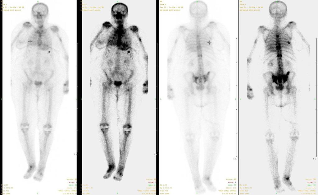 4.2.1.4 Metoda Hybridní zobrazení, skládající se z konvenční celotělové scintigrafie a doplněné v případě abnormální nebo nepřehledné akumulace radiofarmaka SPECT vyšetřením.