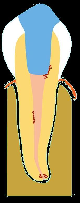 Function of root canal filling 1 2 1. Good seal against infection and liquid 2.