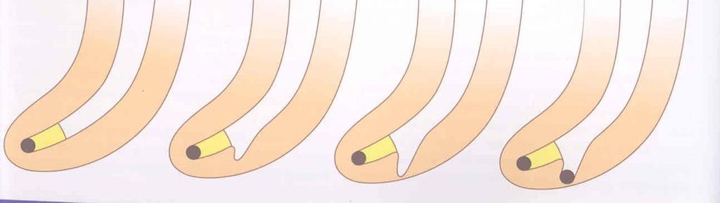 Plug of dentin chips