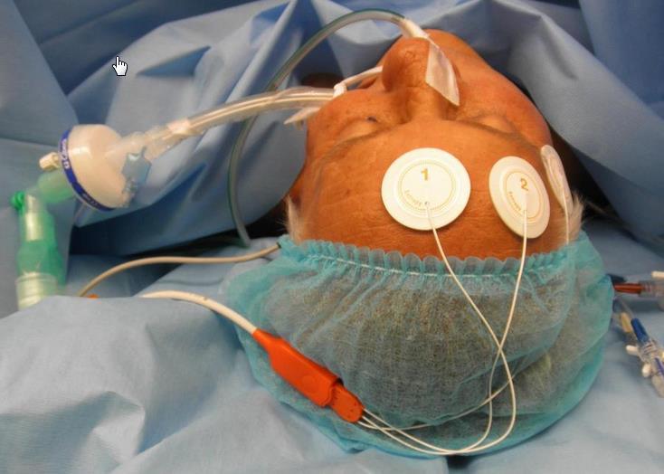 např. SPI (Surgical