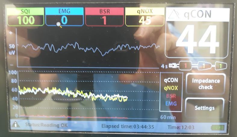 burst suppression > 12 min, qcon a qnox 60 Brit J