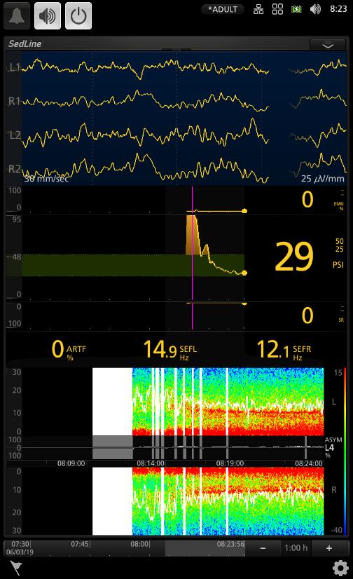 Závěr vzdát EEG monitorování? rozhodně ne!