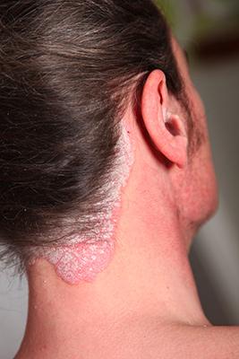 Role kosmetičky v péči o kůži osob s lupénkou Osoby postižené jakoukoli formou psoriázy musí být léčeny dermatologem.
