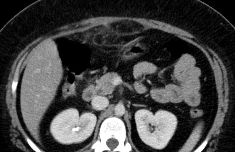 Epiploická appendicitida Radiologický obraz CT