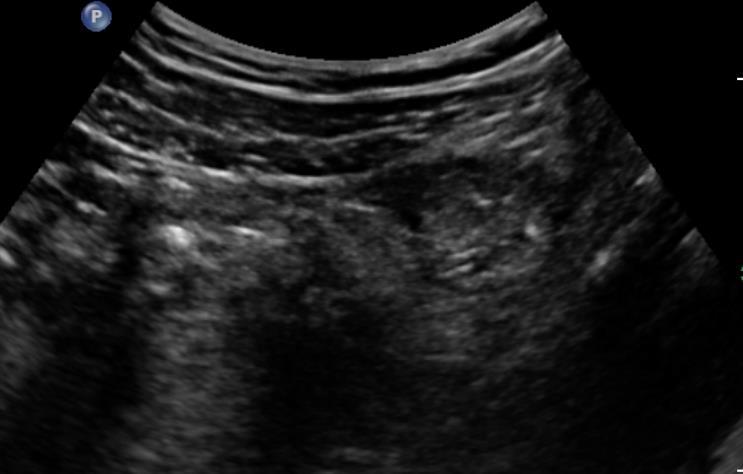 21-letý pacient se 4 dny trvajícími bolestmi v levém hypogastriu v místě největší bolestivosti okrskové prosáknutí okolního tuku parakolicky na