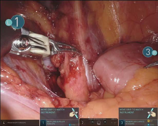 Roboticky asistované operace v gynekologii Díky úsilí managementu nemocnice i zainteresovaných lékařů a sester se v roce 2019 podařilo v naší nemocnici vybudovat centrum robotické chirurgie.
