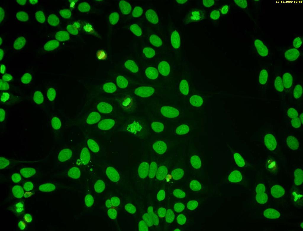 Autoimunitní laboratorní syndrom U laboratorních vyšetření pacientů se často setkáváme se záchytem takzvaných antinukleárních protilátek (zkráceně ANA z anglického označení antinuklear antibodies).