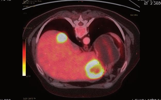 Bronchobiliární píštěl Jiří Škach 1, Vít Machačka 2, Jiří Chalupa 3 1 Chirurgické oddělení, Krajská nemocnice Liberec a.s. 2 Radiodiagnostické oddělení, Krajská nemocnice Liberec a.s. 3 Komplexní onkologické centrum, Krajská nemocnice Liberec a.