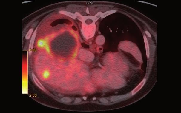 4. září dle nového PET/CT došlo k progresi onemocnění s nálezem pěti ložisek v játrech a jedním v levé plíci. Onkologem byla indikována další linie systémové léčby. 18.